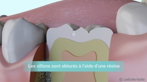 Prévention : le scellement de sillons chez l’enfant