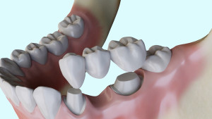 Remplacement d'une dent absente par un bridge