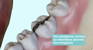 Remplacement d’un amalgame par un inlay